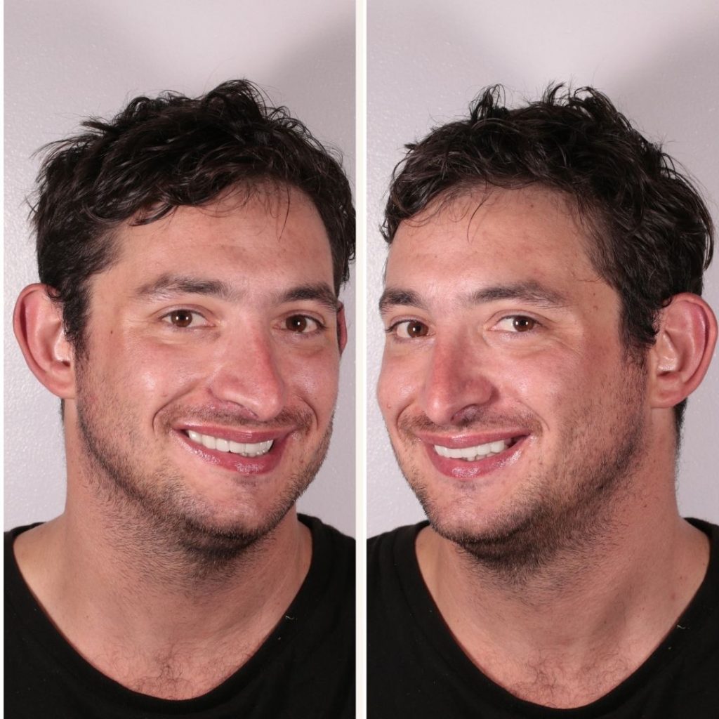 smilemakeover3