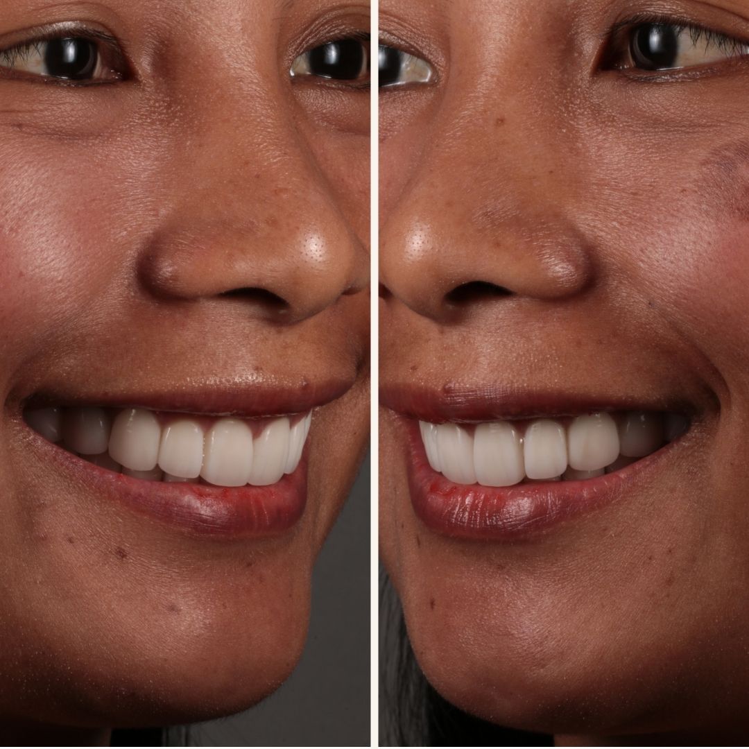 smilemakeover4